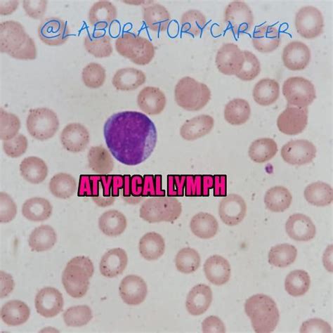 Atypical Lymphocyteslymphs Are Larger Than Normal Lymphs With More