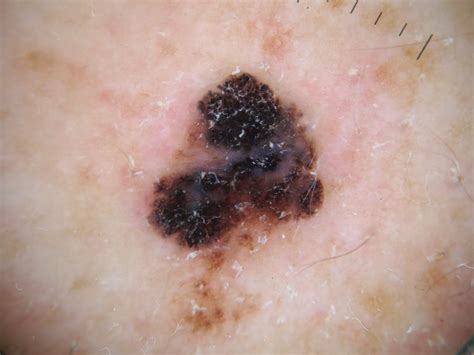 Melanomas On The Face Pictures Photos