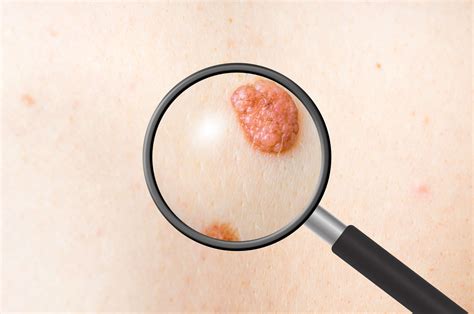 What To Expect From A Skin Biopsy Kavita Rao Md