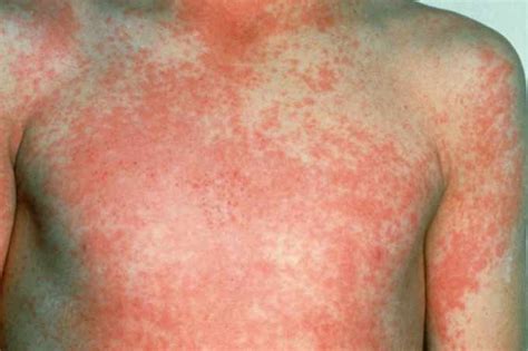 Rashes And Spots Pictures In Toddlers Children And Babies Nhs Doctor
