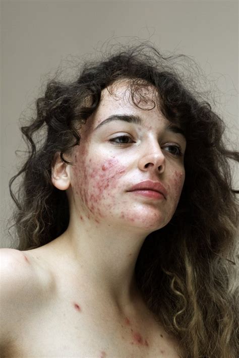 Photos Help Women With Acne Break Down The Stigma Of Skin Conditions