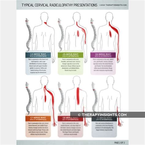 Typical Cervical Radiculopathy Presentations Therapy Materials For