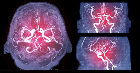 Best Doctors And Hospitals In India For Cerebral Angiogram