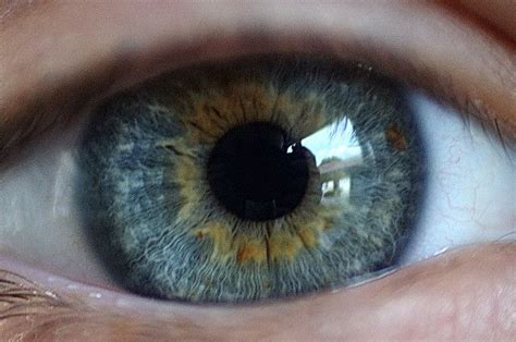 Central Heterochromia Blue Gold