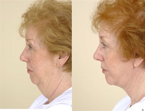 Neck Lift Without The Facelift Plastic Surgeon San Francisco Pacific Heights Plastic Surgery
