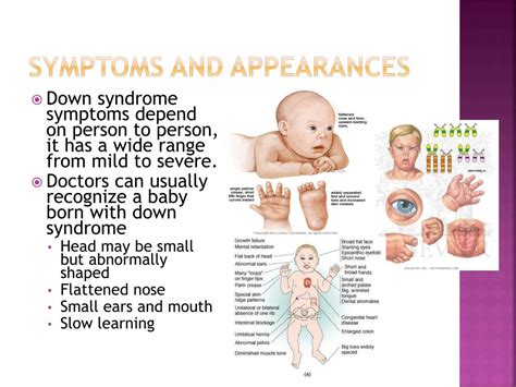 Down Syndrome Symptoms Health Info