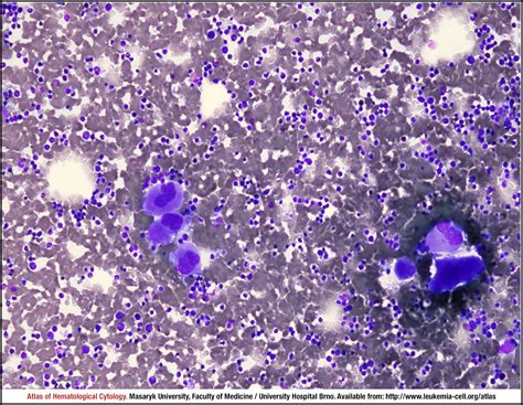 Prefibroticearly Primary Myelofibrosis Cell Atlas Of
