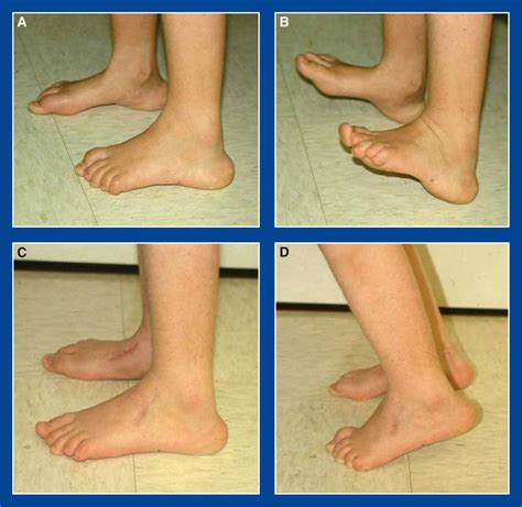 Ankle Foot And Ankle Deformities Principles And Management Of