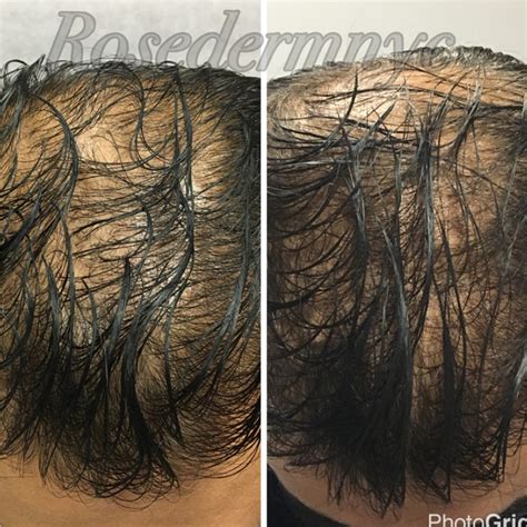 Hair Restoration Astoria Convenient Painless Rose Dermatology