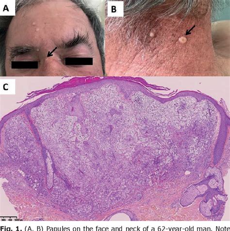 Figure 1 From Umbilicated Papules On The Face Of An Adult Patient A
