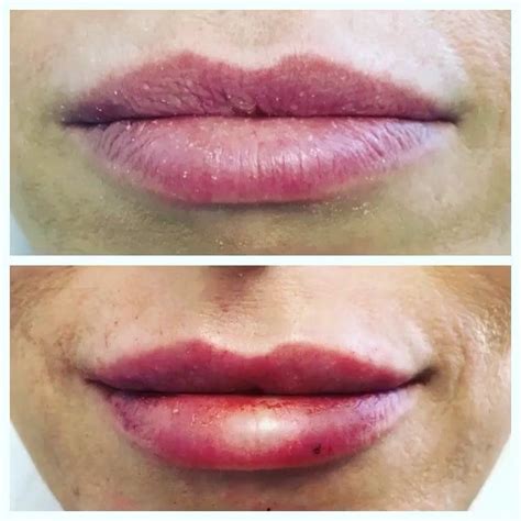Natural Looking Lips That Last Over Time The Lips Tend To Naturally Thin And Vertical Lines
