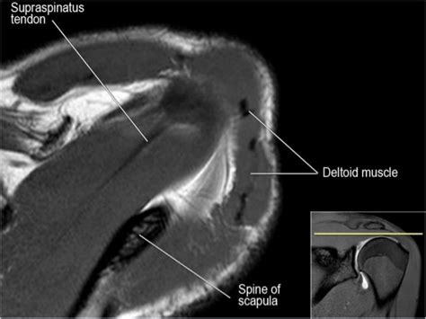 The long head biceps tendon travels through the shoulder joint making it more prone to injury such as a partial tear, rupture, or tendonitis. MRI of Shoulder anatomy