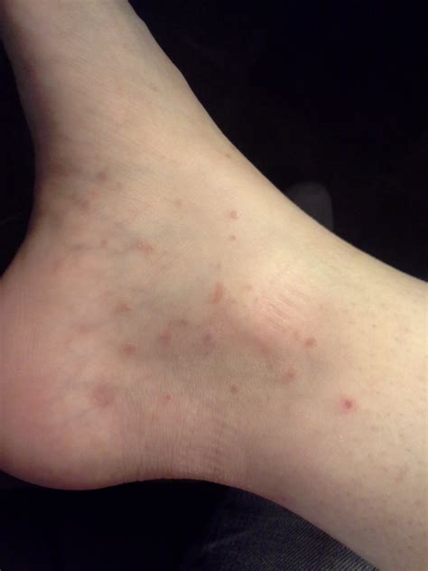 Why Do I Have Red Bumps On My Legs And Feet Printable Templates Protal