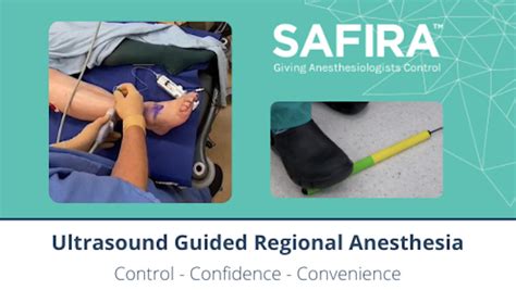 Ultrasound Guided Regional Anesthesia A Single Person Procedure