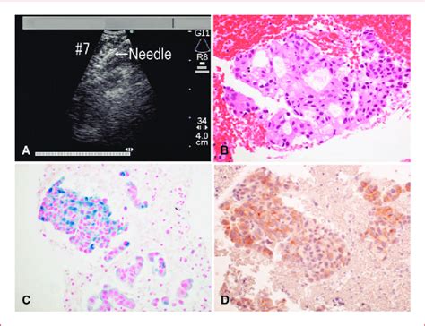 Diagnosis Of Metastatic Nodes By Ebus Tbna A Lymph Node Sampling By