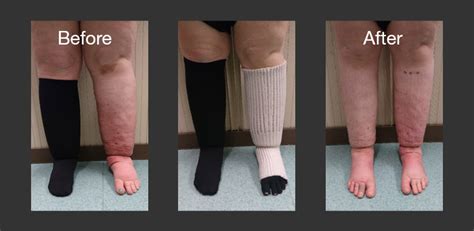 The Benefits Of Using Comfiwave As Part Of Your Lymphoedema Management