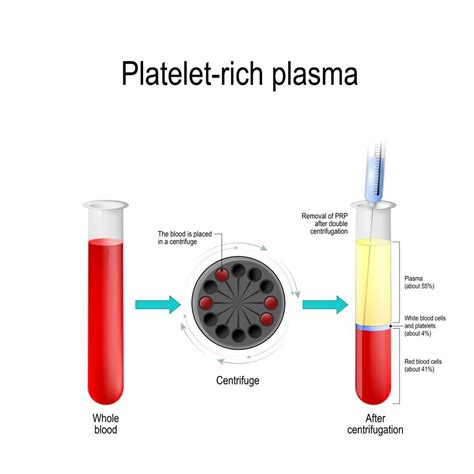Platelet Rich Plasma Treatments Available At Excellence Medical