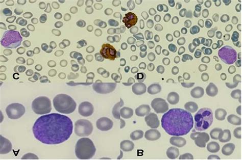 Morphology Of Peripheral Blood A And Bone Marrow From Aspirate B