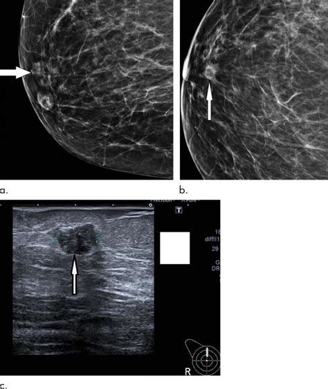 Digital Mammography Increases Breast Cancer D Eurekalert