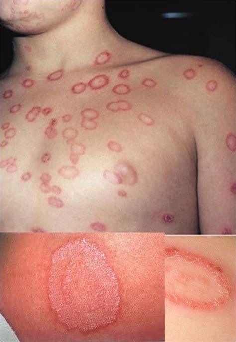 Natural Way To Cure Ringworm