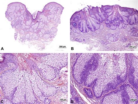 Sebaceous Lesions Of The Skin Pathology