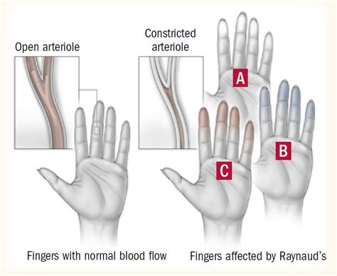 Raynauds Phenomenon Harvard Health