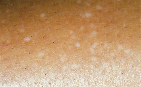 Small White Spots On Arms And Legs Idiopathic Guttate Hypomelanosis