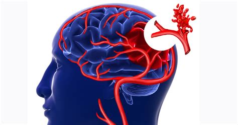 Brain Aneurysm Pictures