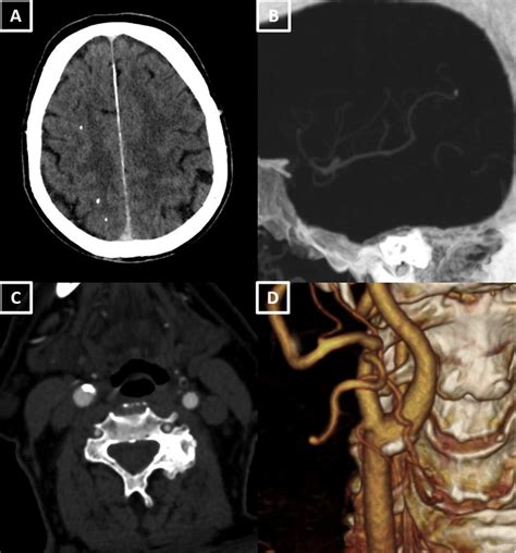 A Axial Contrast Enhanced Cerebral Computed Tomography Cerebral