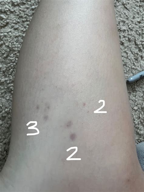 I Get These Purple Spots On My Legsarms Every So Often Theyre Always