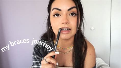 Braces At 25 My Biggest Insecurities My Braces Journey Youtube