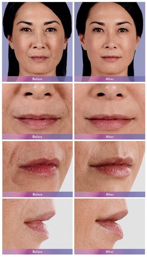 Juvederm Dermal Filler New Orleans And Baton Rouge Qna Cosmetic Surgery