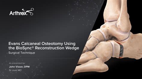 Arthrex Evans Calcaneal Osteotomy Using The Biosync® Reconstruction Wedge