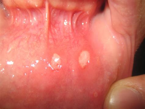 What Is Mouth Rot Symptoms Of The Contagious Disease Smile Delivery Online
