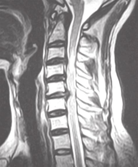 Mri Cervical Spine Sagittal Section Showing Disc Prolapse At C Level