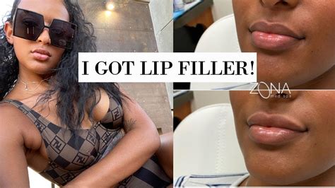 i got lip filler my experience getting lip injections for the first time youtube