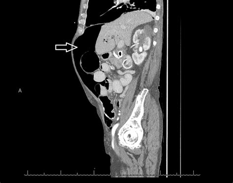 Cureus Massive Pneumoperitoneum Presenting As An Incidental Finding