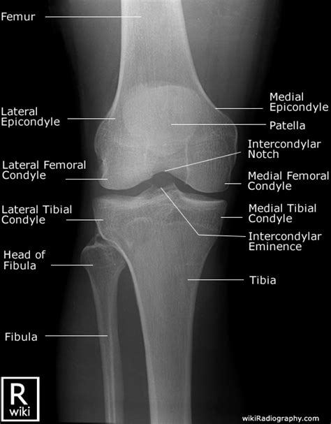 Knee Non Trauma Radiographic Anatomy Wikiradiography