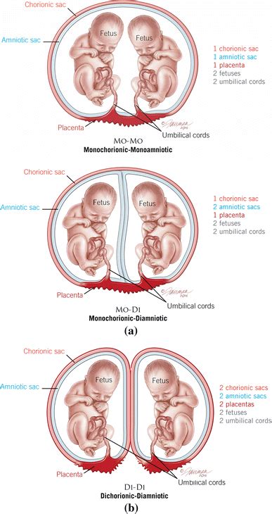 A Monochorionic Monoamniotic Twins Mcma Shown In The Top Image Have