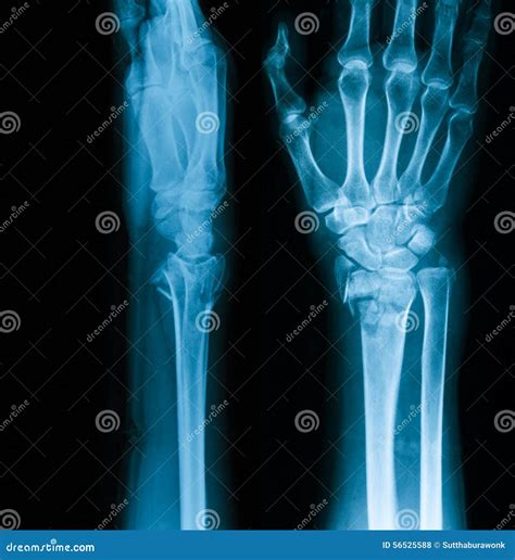 Wrist Bone Anatomy X Ray