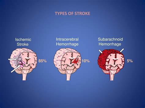 Ppt Acute Stroke Treatment An Introduction Nov 19 Th 2012