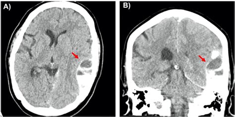 Ct Scan Of The Brain Left Sided Subdural Hematoma With Extension Along