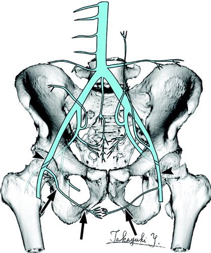 Vascular Dilatation In The Pelvis Identification With Ct And Mr