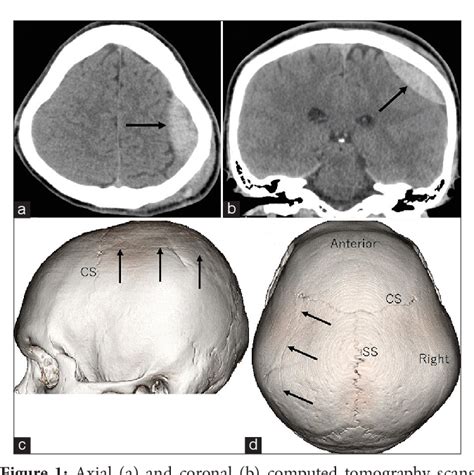 Figure 1 From Traumatic Acute Epidural Hematoma Caused By Injury Of The