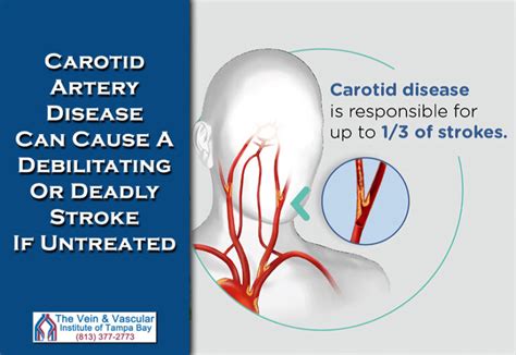 Carotid Artery Disease Tampa Vascular Surgeon The Vein And Vascular
