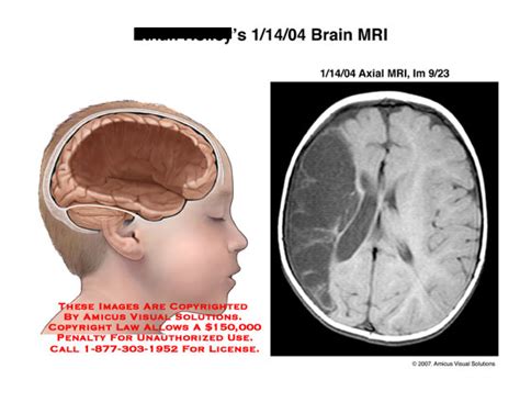 AMICUS Illustration Of Amicus Radiology Medical Brain Cyst Axial Mri