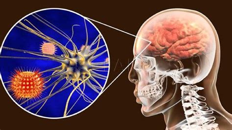Qué Es La Meningitis Aséptica Cuáles Son Sus Síntomas Y Cuál Es Su