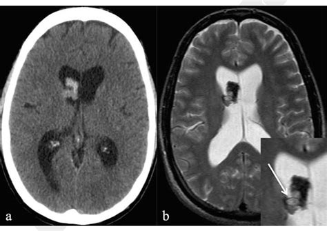 Intraventricular Hemorrhage In Adults Mapasgmaes
