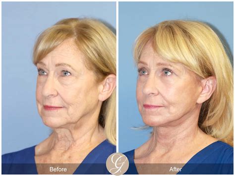 Neck Lift Before After Photos Orange County