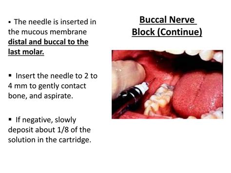 Buccal Nerve Block Technique